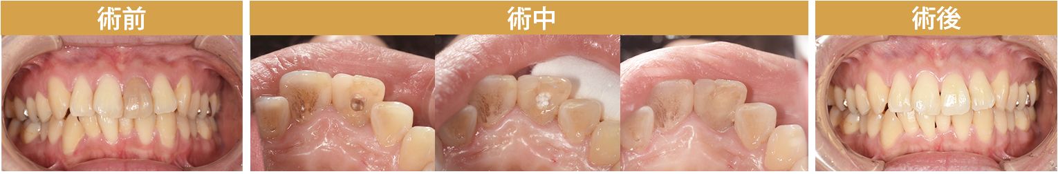 ホワイトニングスライド